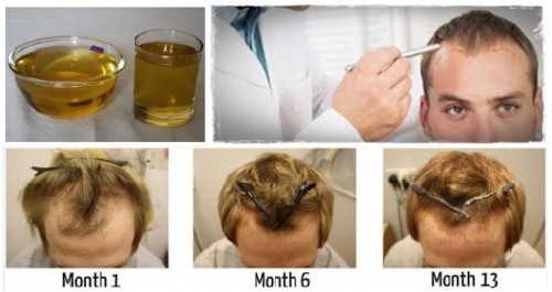 Want to regrow your hair? Use this single ingredient for the same                                 
How to apply castor oil
Here is the way to apply castor oil packs to your hair for maximum benefit.